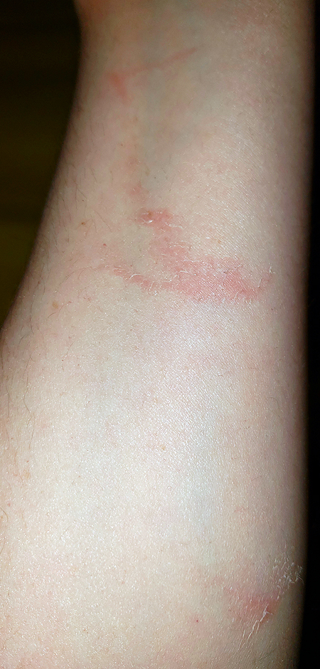 My forearm, bearing multiple scrapes from my fall